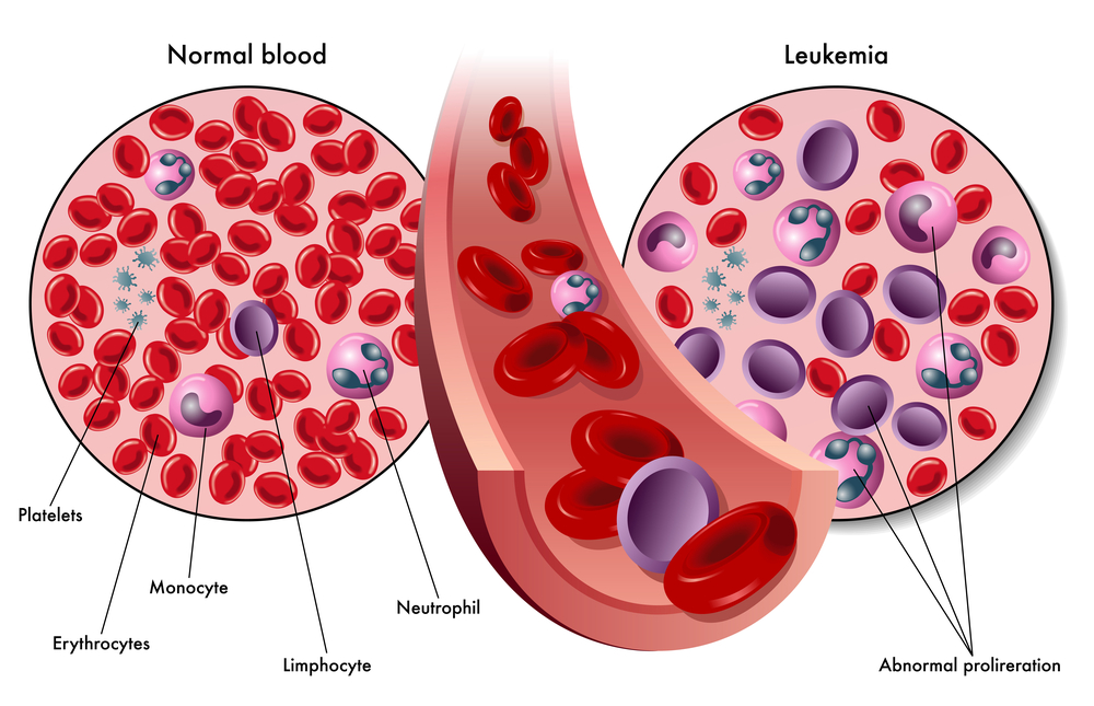 Car-t-cell-therapy-for-leukemia-in-israel.jpg